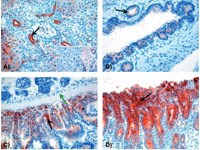 Đặc điểm mô bệnh học và sinh hóa của bệnh sán lá gan lớn