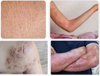 Một số rối loạn da hay gặp vào mùa hanh khô