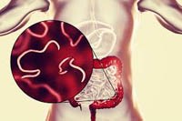 Quản lý điều dưỡng bệnh giun kim (Enterobiasis) do Enterobius vermicularis (Phần 2-Hết)