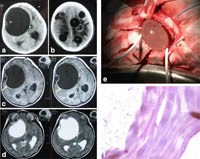 Cập nhật nghiên cứu về bệnh do sán dải chó (echinococcosis) ở người trên thế giới và Việt Nam (Phần 3)