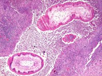 Một số vấn đề điều trị và quản lý ca bệnh ký sinh trùng sán nhái ở người (Phần 4-Hết)