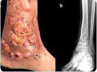 Bệnh u nấm Mycetoma ở người & động vật: từ dịch tễ đến chiến lược điều trị (Phần 2- Tiếp theo)