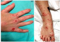 Xử trí vết thương chuột cắn & liệu có mắc bệnh dại không?