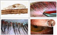 Phần 1. Chẩn đoán và điều trị viêm da viêm da Demodex spp. dựa trên bằng chứng (còn nữa)
