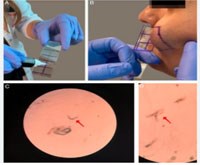 Phần 2. Chẩn đoán và điều trị viêm da viêm da Demodex spp. dựa trên bằng chứng (tiếp theo và hết)