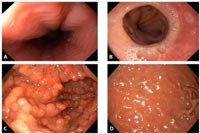 Cập nhật viêm đường tiêu hóa tăng bạch cầu ái toan - Phần 1: Viêm dạ dày ruột tăng bạch cầu ái toan