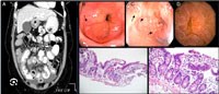 Cập nhật quan điểm viêm đường tiêu hóa tăng bạch cầu ái toan (Eosinophilic gastroenterocolitis): góc nhìn hóa mô miễn dịch và tiêu hóa (Còn nữa)