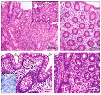 Cập nhật quan điểm viêm đường tiêu hóa tăng bạch cầu ái toan (Eosinophilic gastroenterocolitis): góc nhìn hóa mô miễn dịch và tiêu hóa (tiếp theo và hết)