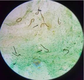 Cập nhật Hướng dẫn Tổ chức Y tế Thế giới về điều trị dự phòng bệnh giun lươn giảm gánh nặng bệnh tật ảnh hưởng đến sức khỏe cộng đồng (Phần 2 và Hết)