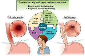 Cập nhật hướng dẫn điều trị và quản lý viêm thực quản tăng bạch cầu ái toan (Eosinophilic esophagitis_EoE) (còn nữa)