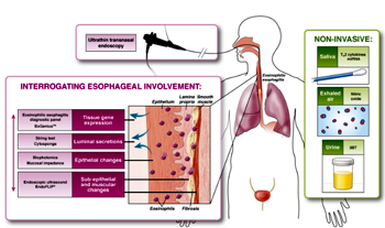 Cập nhật hướng dẫn điều trị và quản lý viêm thực quản tăng bạch cầu ái toan (Eosinophilic esophagitis_EoE) (tiếp theo và hết)