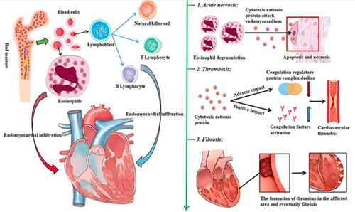 Hội chứng löffler và những điều liên quan đến nhiễm ký sinh trùng qua hệ hô hấp