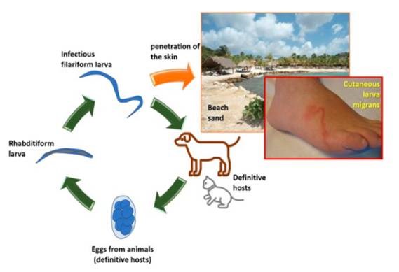 Cập nhật chẩn đoán phân biệt ấu trùng di chuyên dưới da