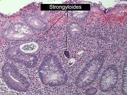 Đồng nhiễm giun lươn trên bệnh nhân suy giảm miễn dich hay có bệnh lý nền: nguy cơ tử vong rất cao (Phần 1)