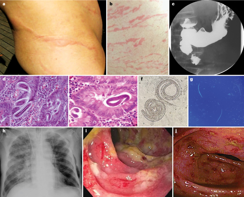 Đồng nhiễm giun lươn trên bệnh nhân suy giảm miễn dich hay có bệnh lý nền: nguy cơ tử vong rất cao (Phần 6-Hết)